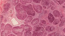 World first: Inhibiting MERTK gene for the treatment of fibrosis in multiple organs