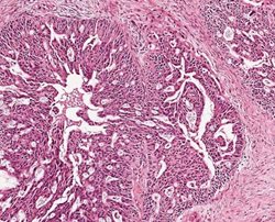 Can our genes help predict how women respond to ovarian cancer treatment?