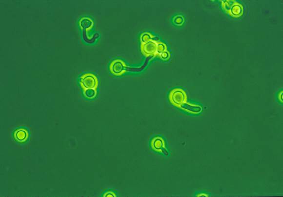 New insights into diagnosing and treating invasive fungal infections will help to save lives