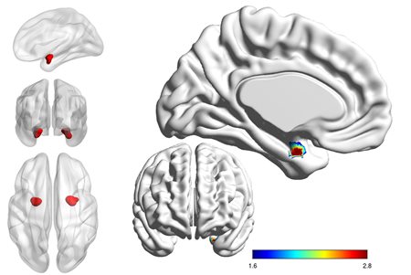 Looking inside the brain to distinguish bipolar from depression