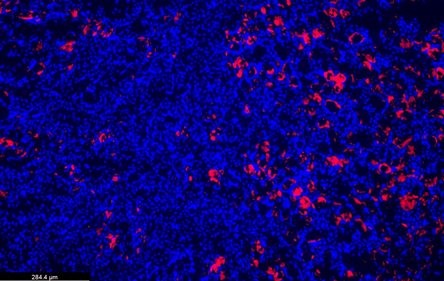 Inflammation ‘brake’ gene may help reveal outcomes of kidney disease