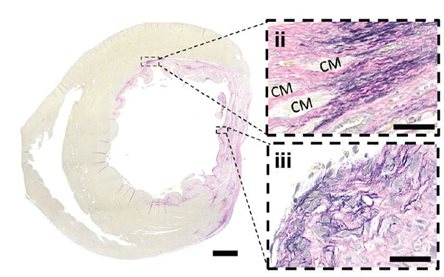 Scientists find way to heal scars caused by heart attacks