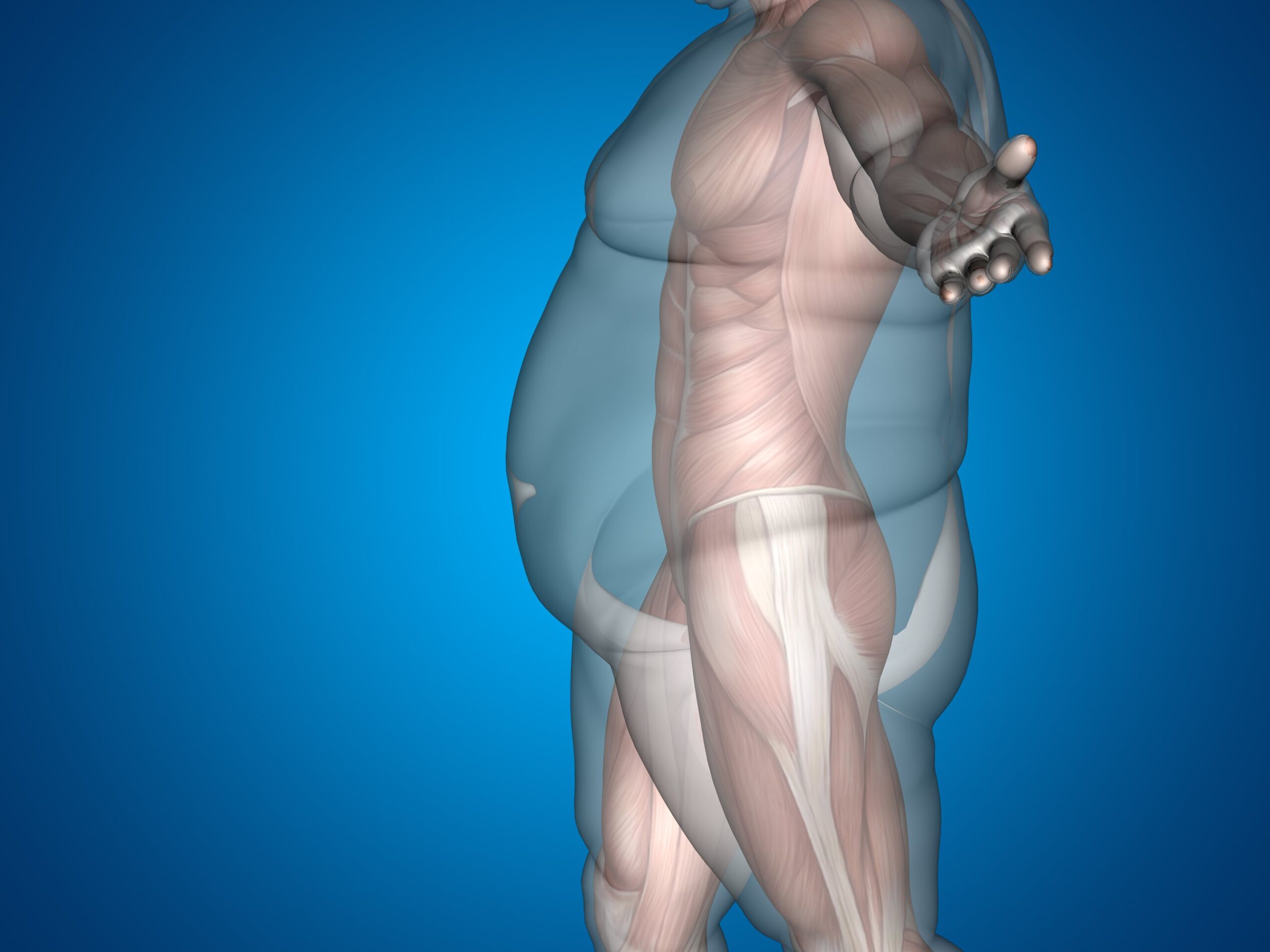 Type 2 diabetes is a multi-system disorder casued by obesity and inactiveity