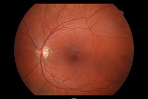 New research: eyes of adolescents could reveal risk of cardiovascular disease
