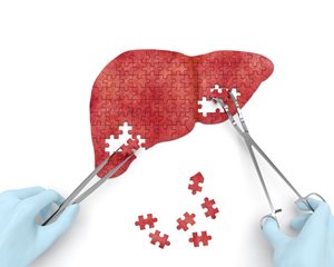 Predictive calculator helps doctors manage liver disease epidemic